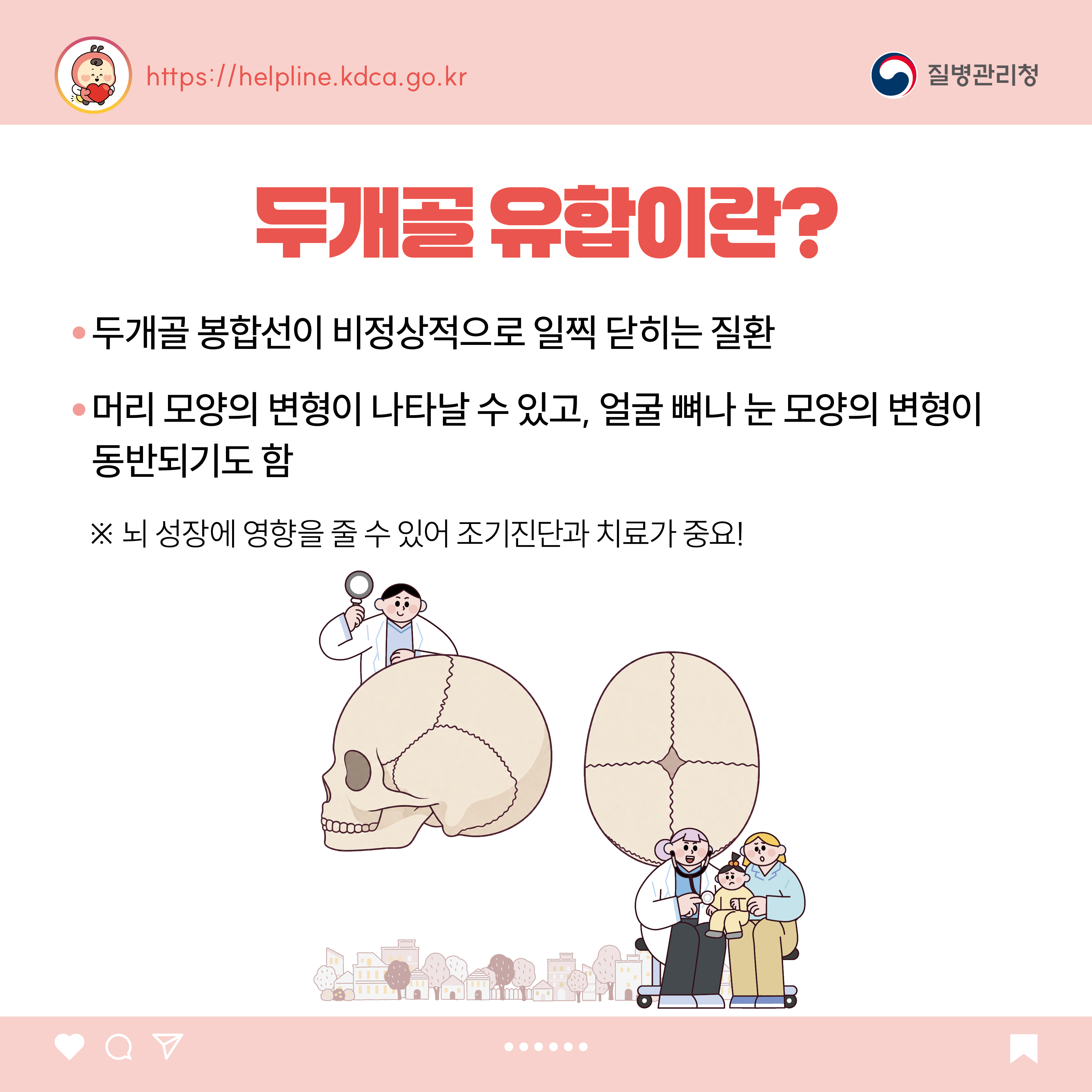두개골 유합이란? - 두개골 봉합선이 비정상적으로 일찍 닫히는 질환 - 머리 모양의 변형이 나타날 수 있고, 얼굴 뼈나 눈 모양의 변형이 동반되기도 함  ※ 뇌 성장에 영향을 줄 수 있어 조기진단과 치료가 중요!